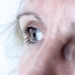 Blepharoplasty